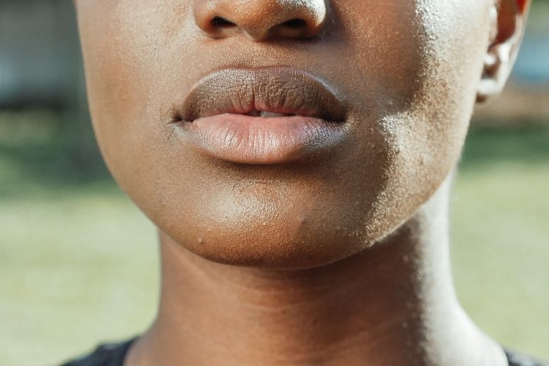 Waarom je in de zomer sneller een koortslip kunt krijgen