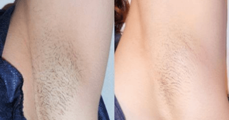 Wil je snel en eenvoudig van je okselhaar afkomen? Probeer DIT natuurlijke middel eens!