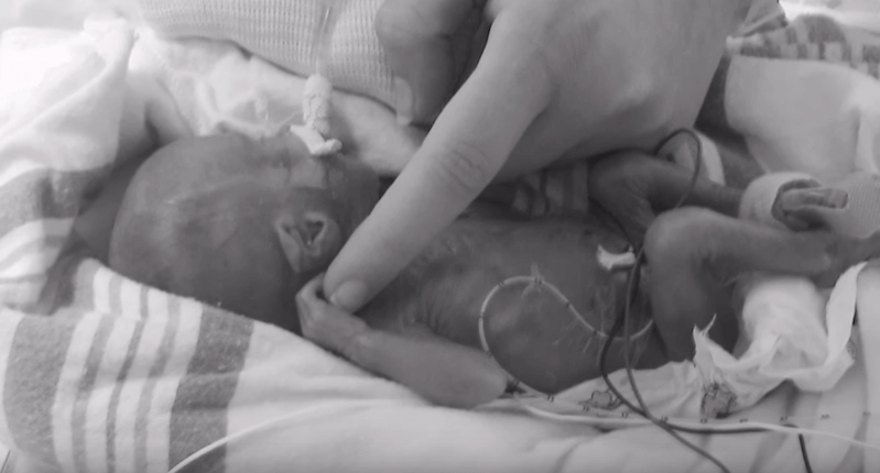 Deze 'wonderbaby' woog maar 300 (!!) gram bij de geboorte... Zo ziet ze er NU uit!