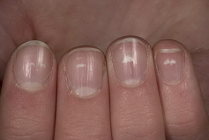 Wist jij al waar die witte vlekjes op je nagels vandaan komen? Wij nu wel!
