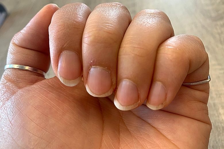 Last van een nagelriemontsteking? Dit is alles wat je erover moet weten