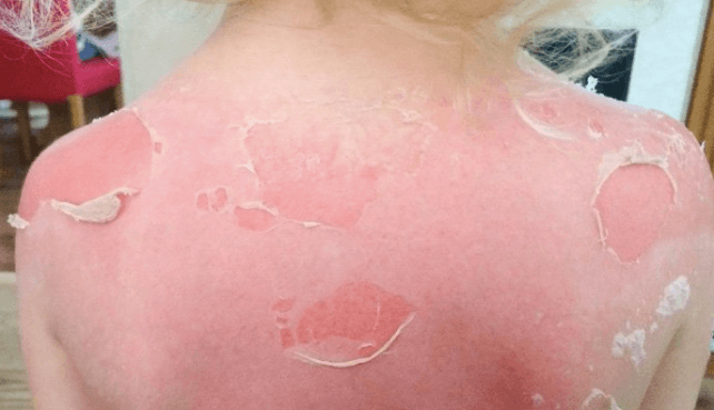 Heftig: 3-jarige jongen ernstig verbrand ondanks insmeren met zonnebrandcrème