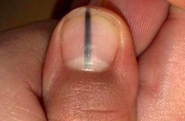 Nagelstyliste ziet zwarte streep op een nagel en wil nu iedereen waarschuwen voor de gevolgen