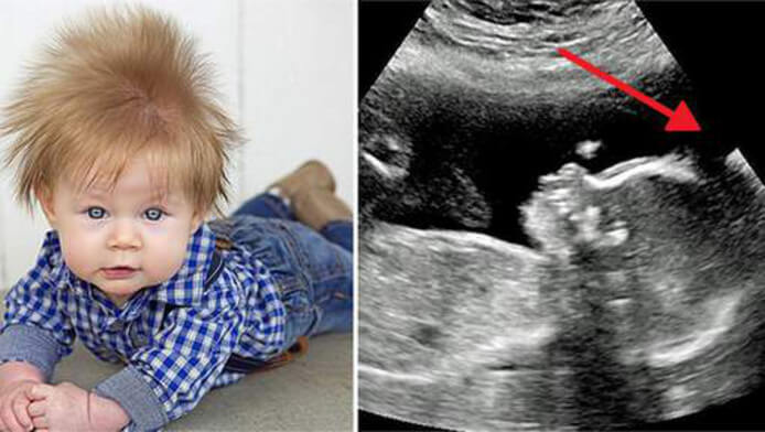 De enorme haardos van deze baby was al zichtbaar op de echo! Heb jij ooit zoiets gezien?!