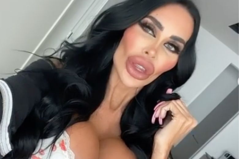 Shocking: vrouw telt 62.000 euro neer voor plastische chirurgie