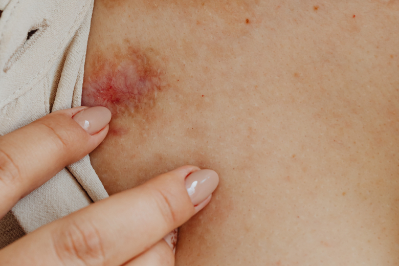 Huidaandoening? Dit moet je weten over eczeem en psoriasis