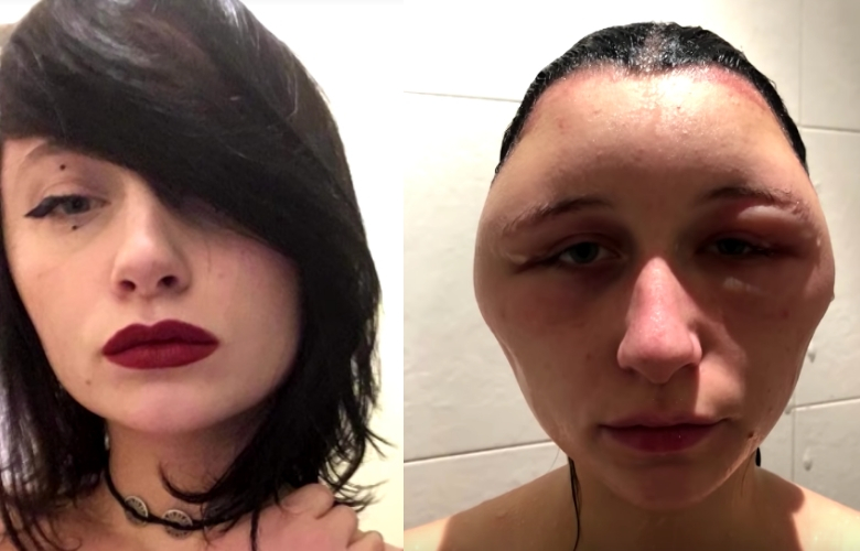 Studente Estelle kreeg een ‘hoofd als een gloeilamp’ na heftige allergische reactie op haarverf