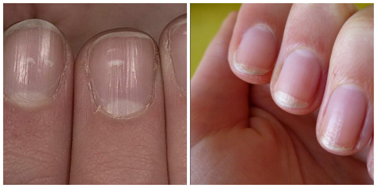 Heb jij wel eens goed naar je handen gekeken? DIT zeggen je nagels over je gezondheid!