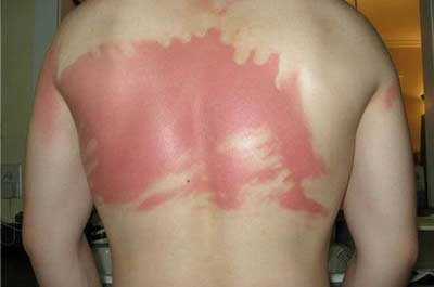 Met dit  simpele trucje kun je zonnebrandcrème op je eigen rug smeren! Ideaal!