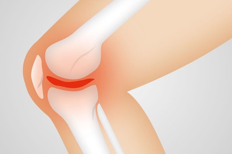 Deze veelvoorkomende klacht kan een voorteken van artrose zijn