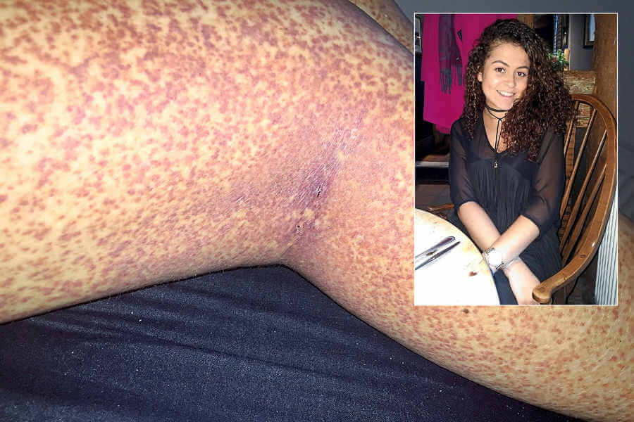 BIZAR: deze vrouw dacht dat ze scheerbultjes had maar de waarheid was veel erger...