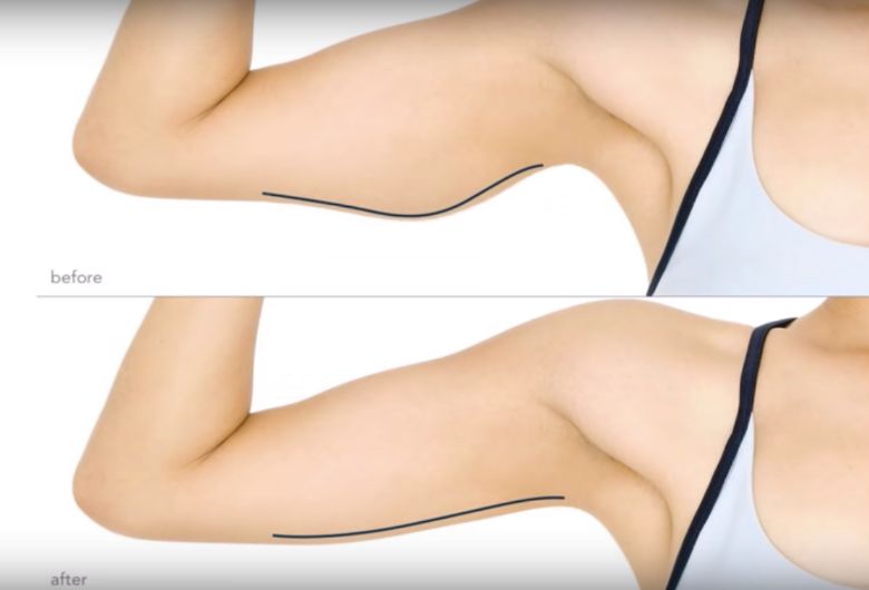Slappe 'kipfilets' aan je bovenarmen? Doe deze oefeningen dan eens