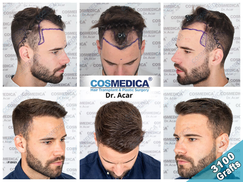 haartransplantatie cosmedica