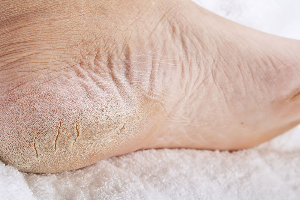 Molestas y dolorosas: ¡ fisuras en el talón ! Este remedio natural brinda alivio instantáneo