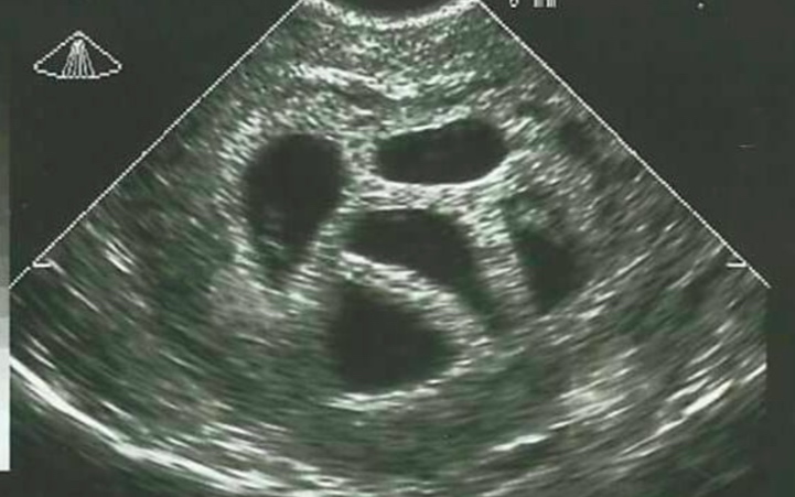 Esta madre se negó a abortar sus quintillizos. Veinte años después, ¡muestra esta imagen! ¡Wow esto es increíble!